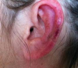 Painful Purpura and Cutaneous Necrosis | MDedge Dermatology
