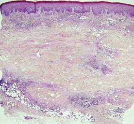 necrobiosis lipoidica diabeticorum pathology