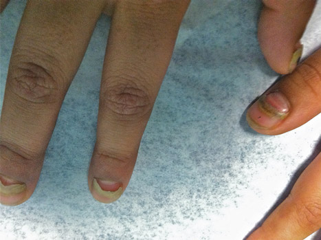 What Is Your Diagnosis? Onychomadesis Following Hand-foot-and-mouth Disease  | MDedge Dermatology