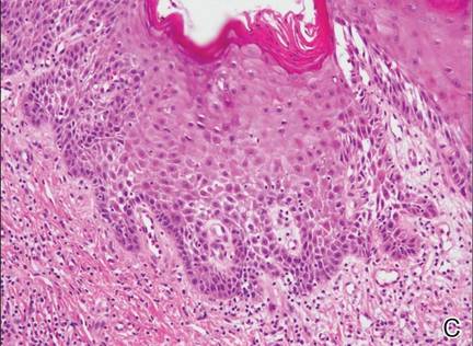 Vulva lichen sclerosus Lichen sclerosus