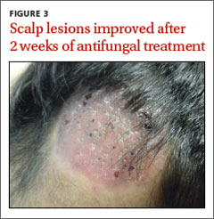 Inflammatory masses on boy’s scalp | MDedge Family Medicine