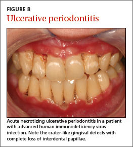 Download Malignant Melanoma On Gums Symptoms PNG