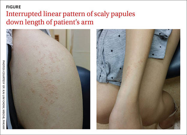 Linear Rash From Shoulder To Wrist Mdedge Family Medicine