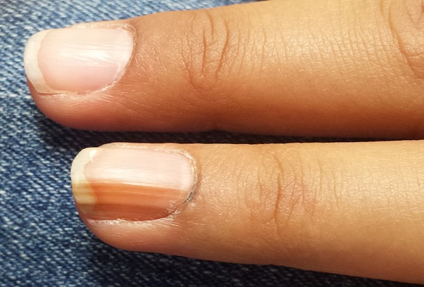 Any ideas why my thumb nail keeps getting these stripes? How do i fix it? :  r/TheGirlSurvivalGuide