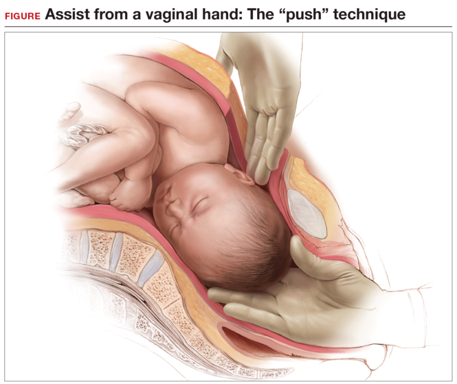STOP using instruments to assist with delivery of the head at cesarean