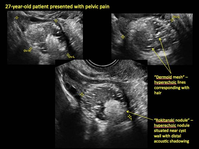 Ovarian Dermoid Cyst Collection Of Ultrasound Images
