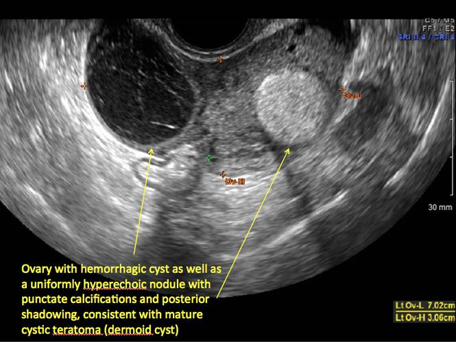 Dermoid Ovarian Cyst On Ultrasound | My XXX Hot Girl