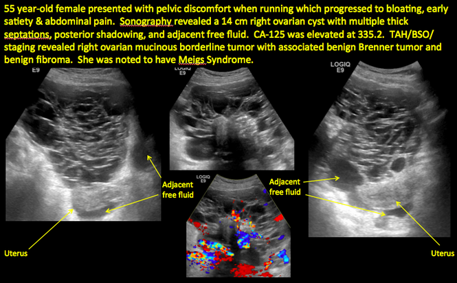 Ovarian Cancer Tumor Ultrasound
