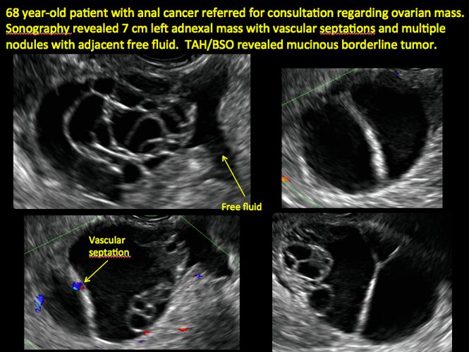 Imaging The Suspected Ovarian Malignancy 14 Cases Mdedge Obgyn