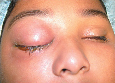 You Woke Up With Swollen Eyes or Eyelids? Don't Panic!