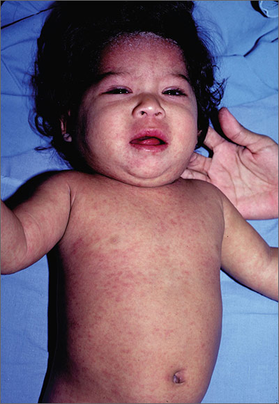 measles rash face