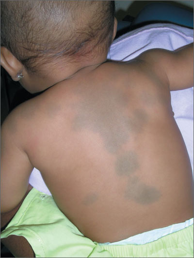 Dark spots on child's back