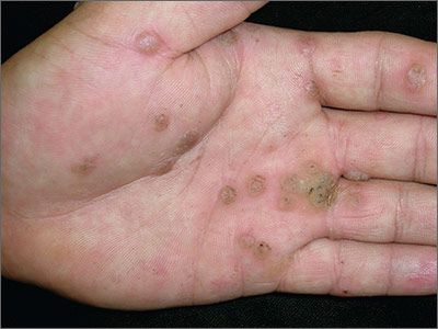 human papillomavirus infection on hands)