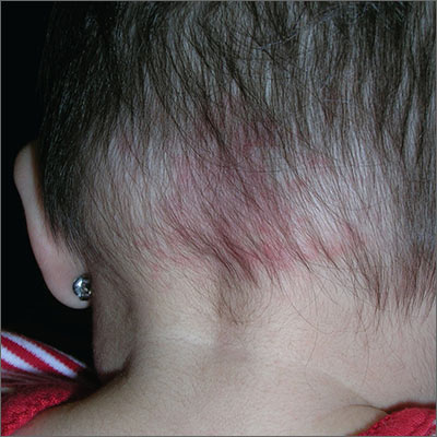 Credential Installere indeks Red area on back of scalp | MDedge Family Medicine