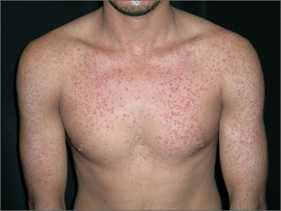 Pruritic rash on chest  MDedge Family Medicine