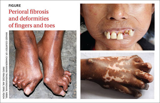 Stiff Hands And Feet Facial Deformities MDedge Family Medicine