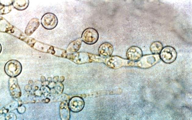 Candida Linked To Sex specific Schizophrenia Symptoms MDedge Psychiatry