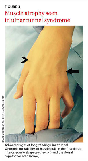 Hand compression neuropathy: An assessment guide | MDedge Family Medicine