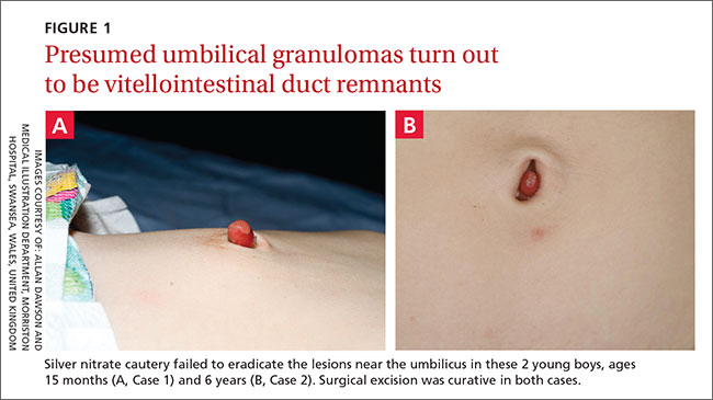 Umbilical Granuloma: Causes, Treatment, Aftercare