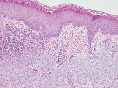 Biopsy from the edge of an ulcerated lesion on the left hand revealed papillary dermal edema with a dense, bandlike neutrophilic infiltrate and hemorrhage (H&E, original magnification ×10). 