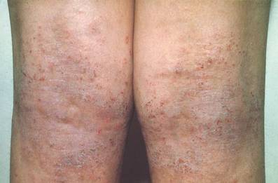 Atopic dermatitis on the bilateral popliteal fossae. Photograph printed with permission from the Graham Dermatopathology Archive, Wake Forest University School of Medicine, Winston-Salem, North Carolina. 