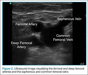 blood clot in leg ultrasound