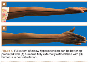hyperextension arm