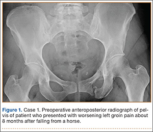 superior pubic ramus fracture