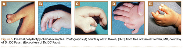Polydactyly Of The Hand MDedge Surgery Polydactyly Of The Hand MDedge Surgery
