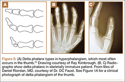 Long-term results following osteotomy of the thumb delta phalanx