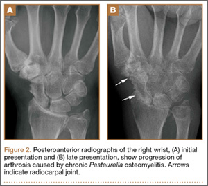 Septic Arthritis And Osteomyelitis Caused By Pasteurella Multocida MDedge Surgery