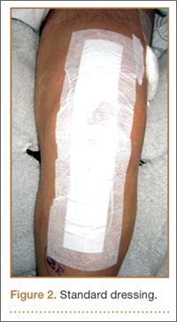 Surgical Wound Dressing Types