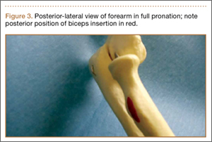 Supination Pronation Test  Distal Biceps Tendon Rupture 