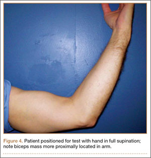 Supination Pronation Test  Distal Biceps Tendon Rupture