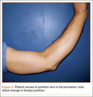 Supination Pronation Test  Distal Biceps Tendon Rupture