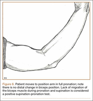 Supination Pronation Test  Distal Biceps Tendon Rupture 