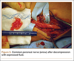 Successful Surgical Treatment of an Intraneural Ganglion of the