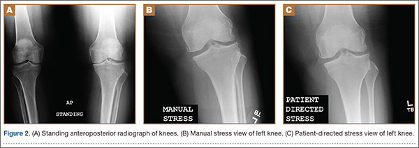 Patient-Directed Valgus Stress Radiograph of the Knee: A New and Novel ...