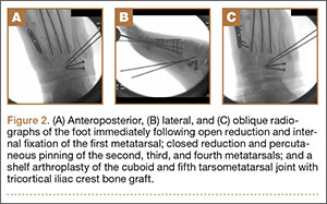 Anterior Approach To The Iliac Crest