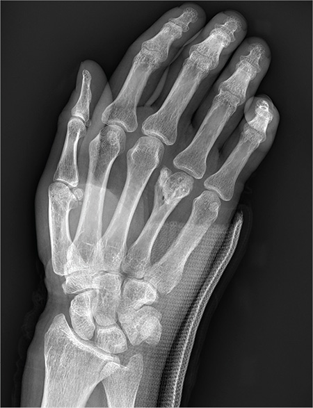 Fracture, pain, orthopedics image