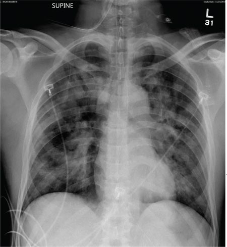 He's intubated and unresponsive, with a Glasgow Coma Scale score of 3T.