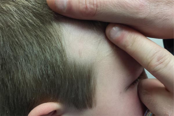 Boy Has Had “Bald Spot” Since Birth | Clinician Reviews