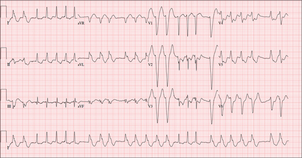 A 72-year-old woman presents with a racing heart and a likely diagnosis.