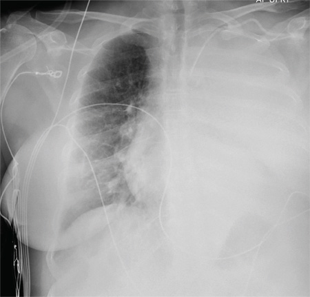 What is the causes of the patient's sudden mild-to-moderate dyspnea and tachypnea? 