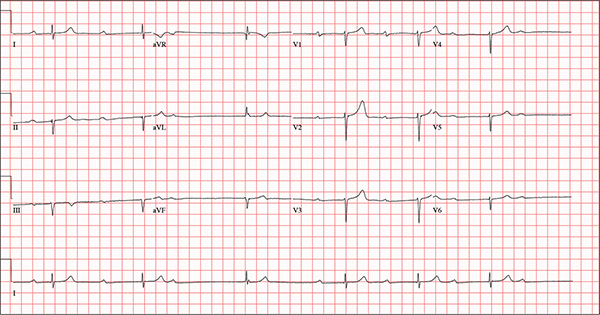 Sinus bradycardia, second-degree atrioventricular block image