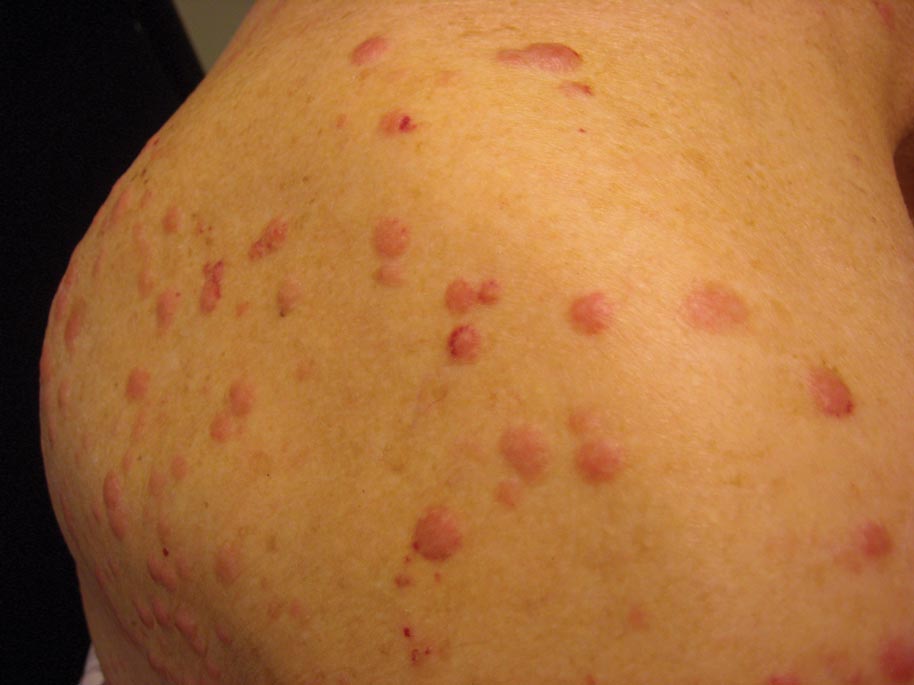 Multiple Firm Pink Papules And Nodules Mdedge Dermatology
