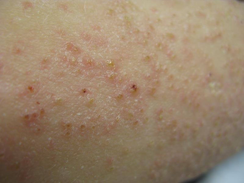 Dry Scaly Spots On Skin