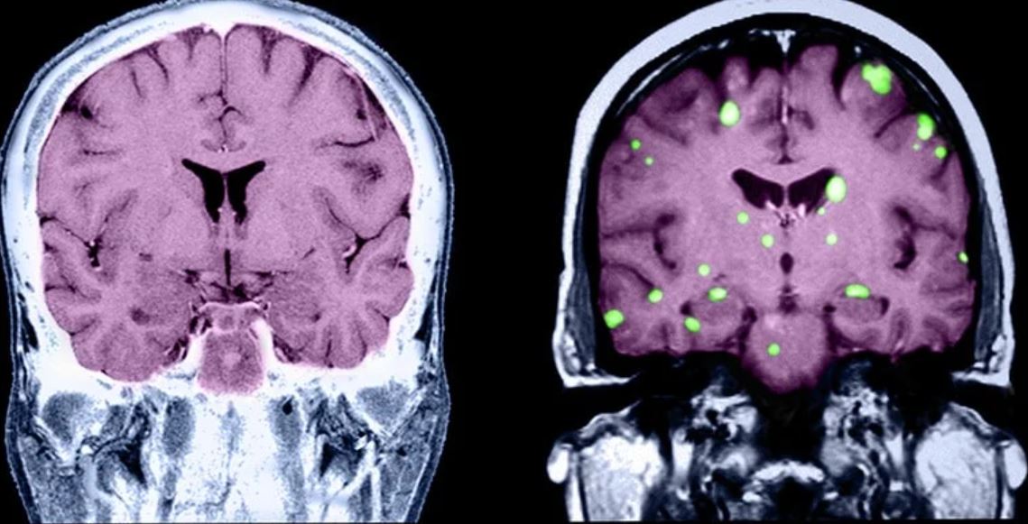 two brains, one with metastases