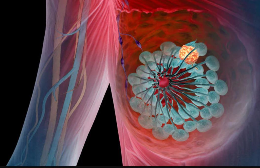 breast cancer illustration