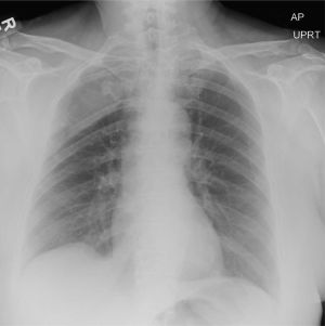 Chest radiograph